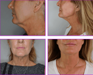 Facelift before and After Photos in Las Vegas