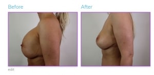 Patient Photos of Breast Implant Removal