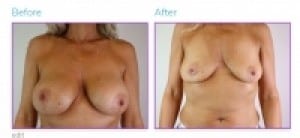 Before and After Photos of Breast Implant Removal