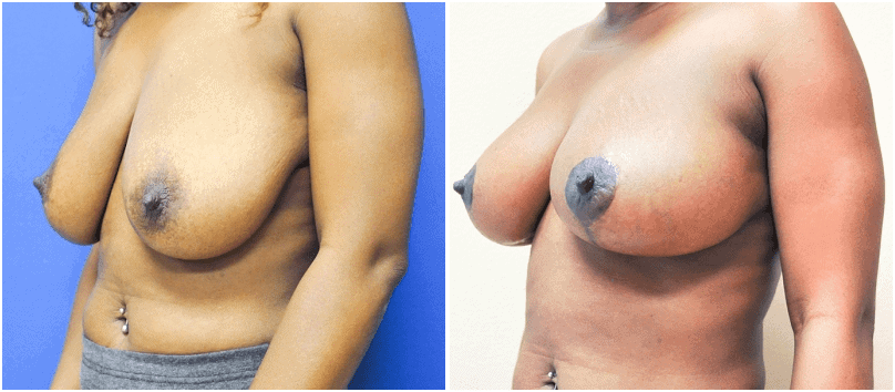 before and after breast lift | Stephen M. Miller MD Plastic Surgery