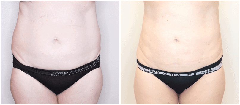 liposuction before and after photos - Stephen M. Miller MD Plastic Surgery