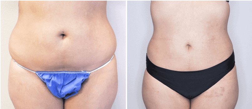 liposuction patient - before and after | Stephen M. Miller MD Plastic Surgery