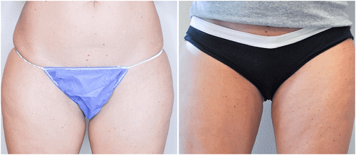 before and after liposuction of the thighs | Stephen M. Miller MD Plastic Surgery