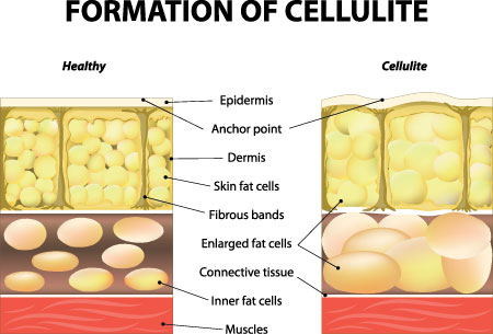 Causes of cellulite in women and men 