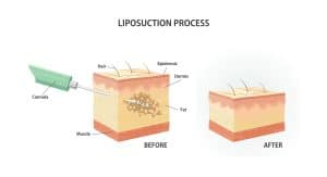 Liposuction Techniques in Las Vegas 